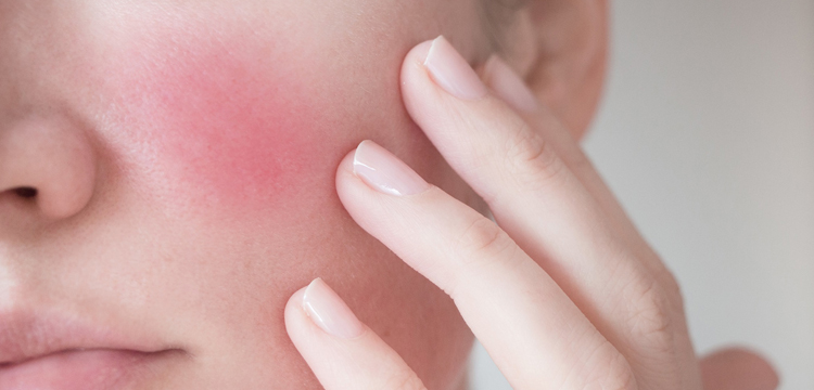 Memahami Tanda-Tanda Umum Kulit Sensitif dengan Lebih Baik